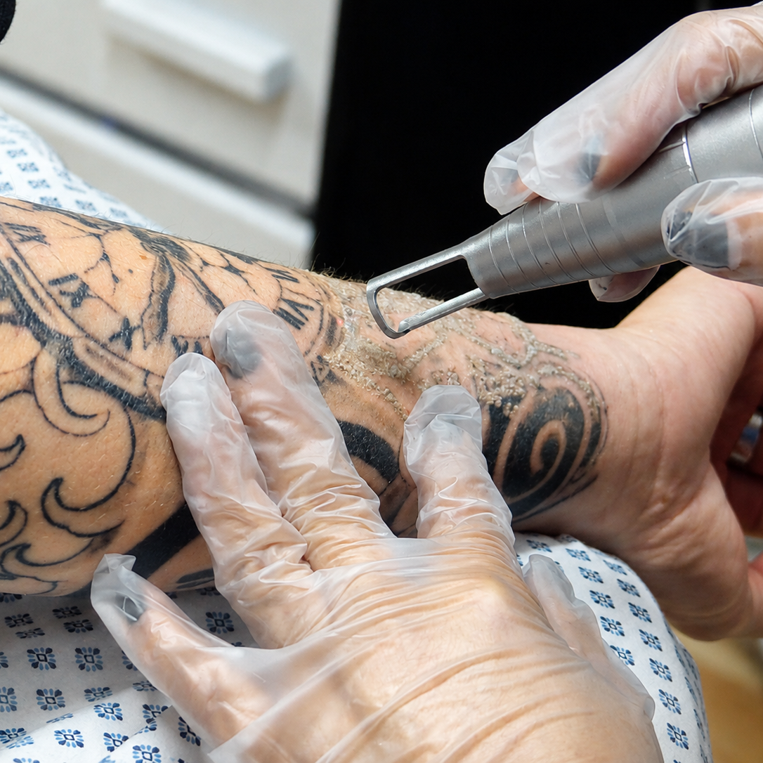 Eliminación de tatuaje 21 a 30 cm