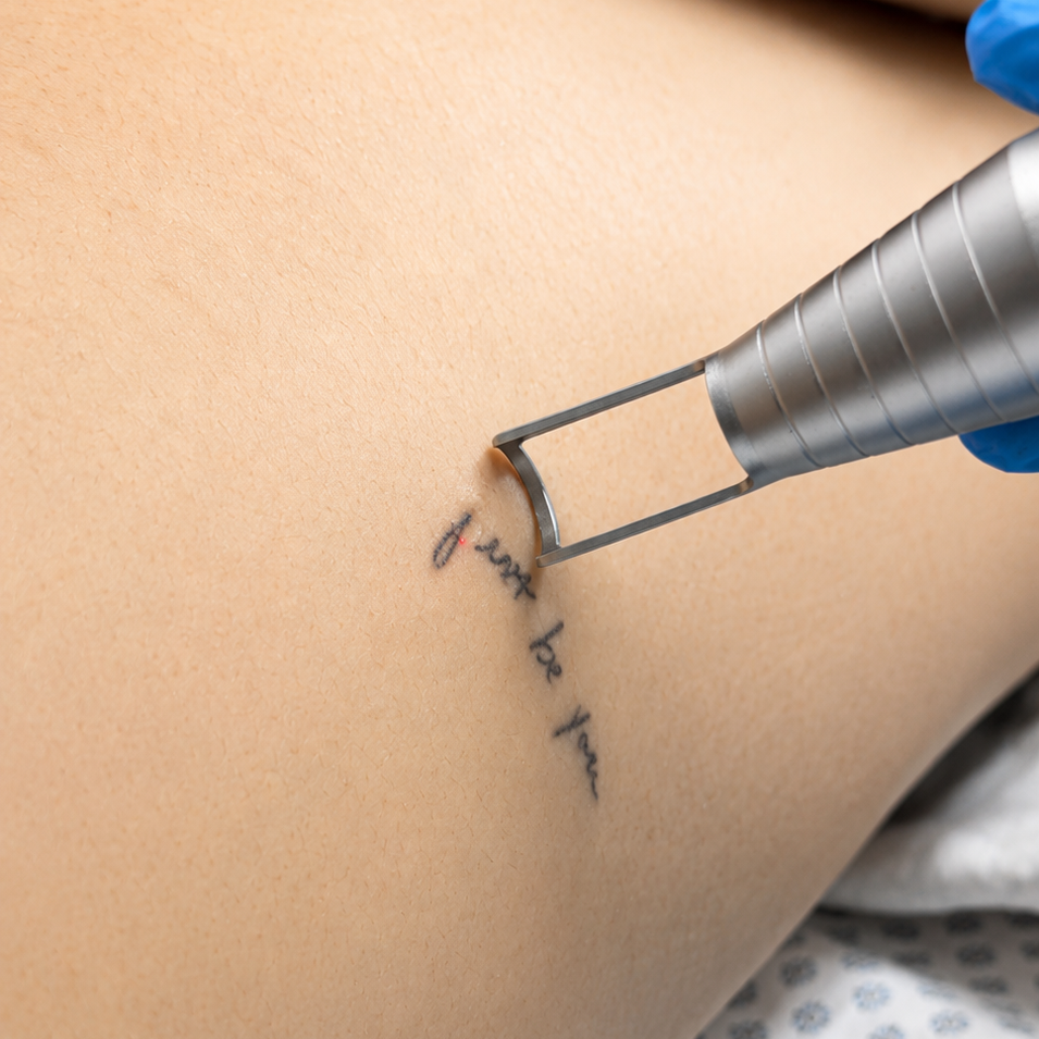Eliminación de tatuaje 7 a 10 cm