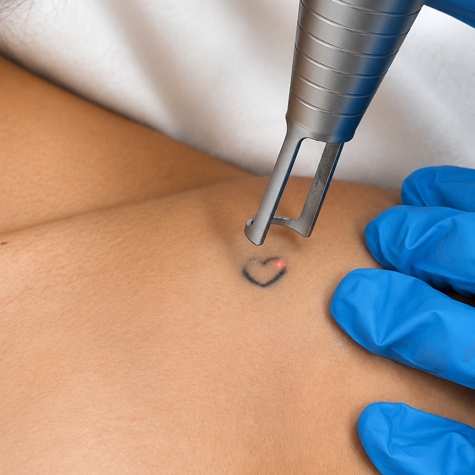 Eliminación de tatuaje 0 a 3 cm