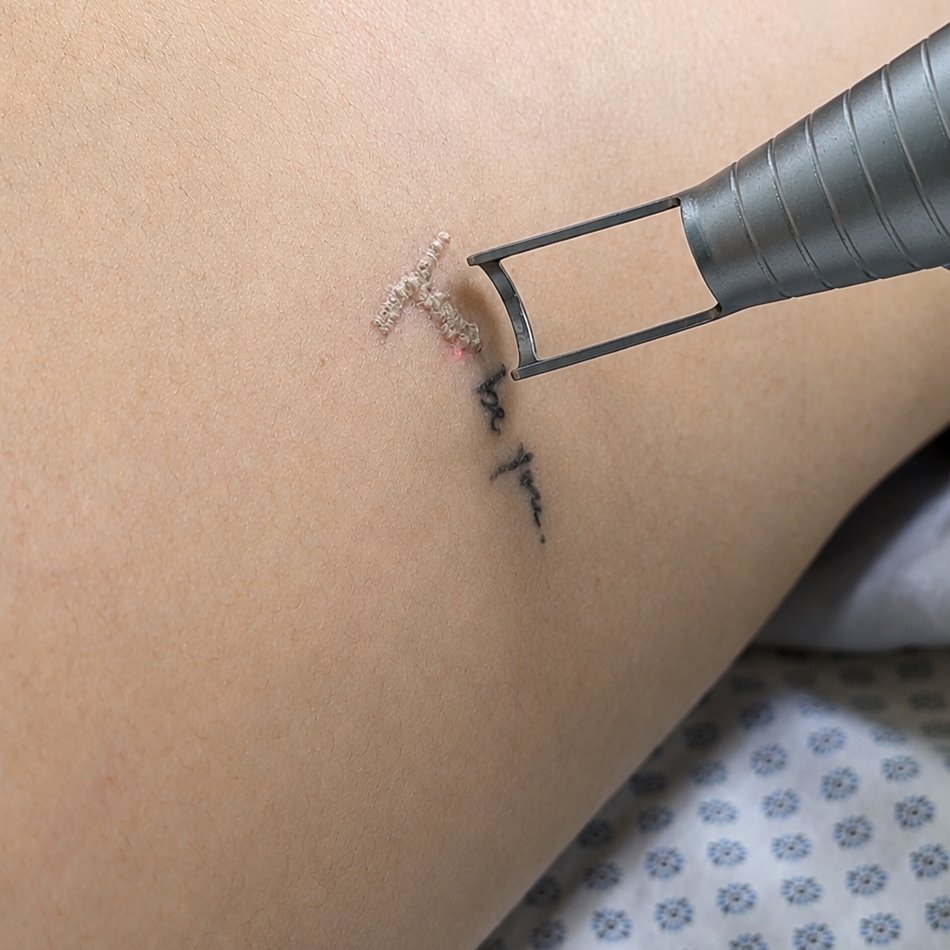 Eliminación de tatuaje 7 a 10 cm